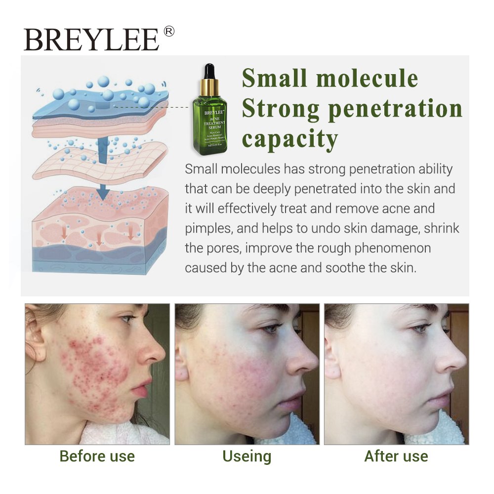 Clear Skin Pimple Solution