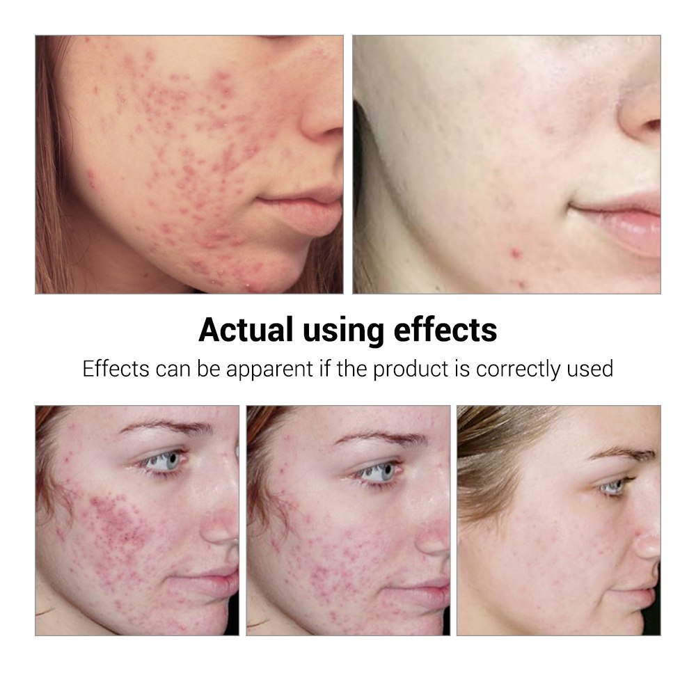 Clear Skin Pimple Solution