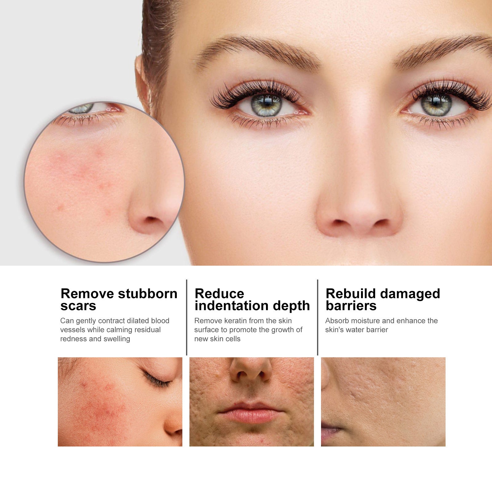 Niacinamide Facial Serum For Fading Acne Marks