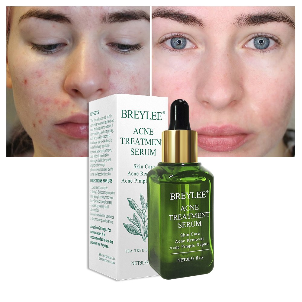 Clear Skin Pimple Solution